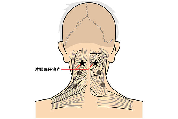 片頭痛圧痛点の位置